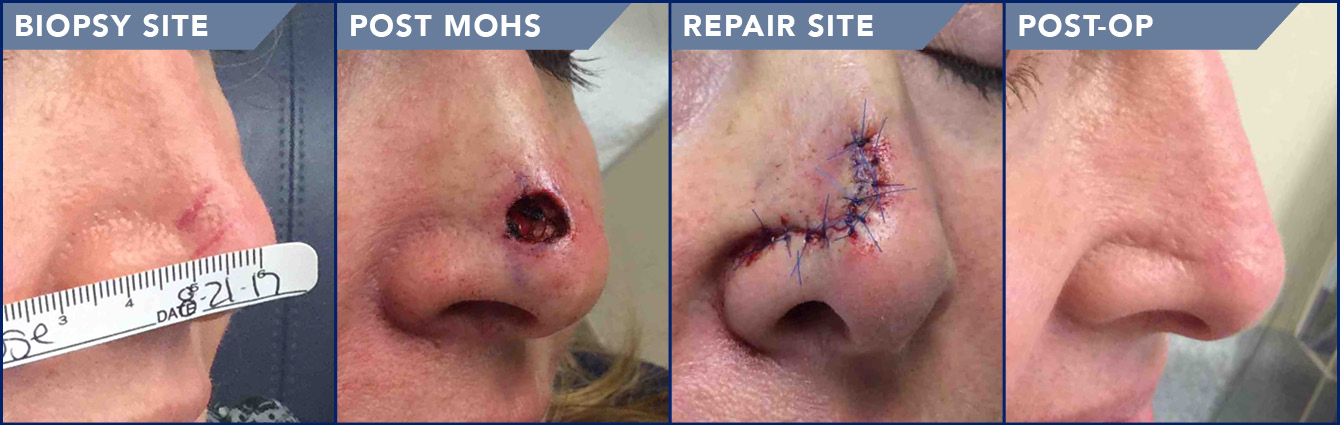 Mohs Micrographic Surgery Photos | Soderstrom Skin Institute