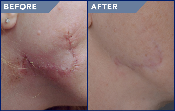 Laser Scar Removal Photos - Soderstrom Skin Institute
