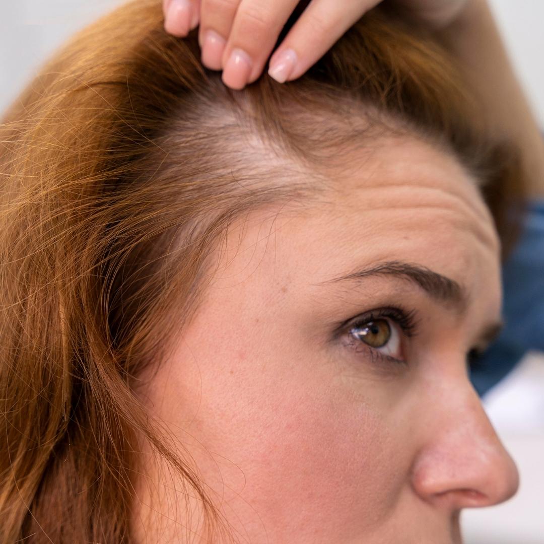 What Causes Hair Loss? - Soderstrom Skin Institute